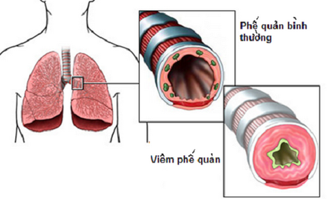 Mật ong trong b&#224;i thuốc trị vi&#234;m phế quản