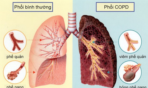 Phương thuốc hay phòng trị bệnh hô hấp mạn tính