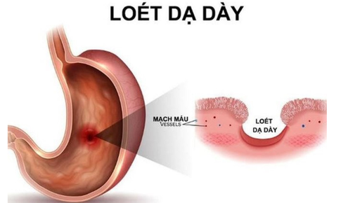 Vi&#234;m lo&#233;t dạ d&#224;y do tự &#253; d&#249;ng thuốc giảm đau