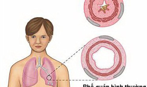 Nguy&#234;n nh&#226;n v&#224; c&#225;ch ph&#242;ng hen phế quản