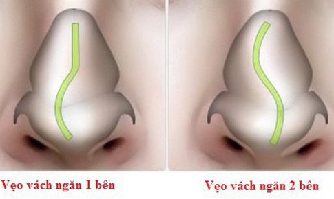 Biến chứng đ&#225;ng ngại do vẹo v&#225;ch ngăn mũi