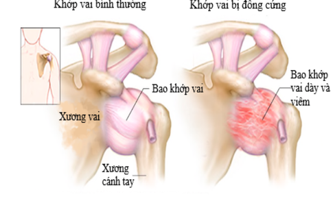 Bi&#234;́n chứng cơ xương khớp do đái tháo đường