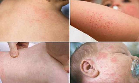 Xử trí trẻ bị ban nhiệt do nóng