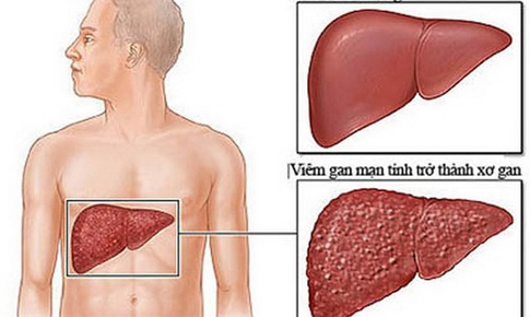 B&#224;i thuốc trị vi&#234;m gan mạn