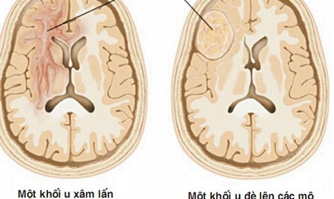 Dấu hiệu cảnh b&#225;o u n&#227;o