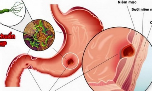 Nhận biết vi&#234;m dạ d&#224;y - t&#225; tr&#224;ng