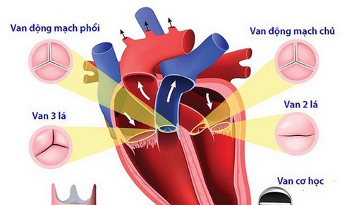 Phẫu thuật van tim: Những điều cần biết