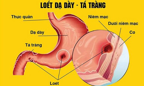 C&#225;c biến chứng dễ gặp khi vi&#234;m dạ d&#224;y