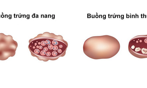 T&#225;c hại do dậy th&#236; sớm ở b&#233; g&#225;i