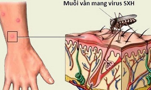 Điều cần biết về sốt xuất huyết v&#224; biến chứng của bệnh