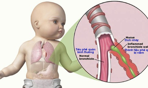 C&#225;ch giảm thiểu trẻ mắc vi&#234;m phế quản