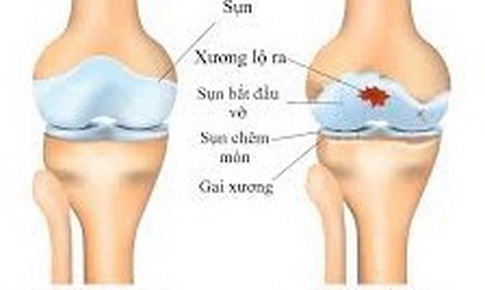 Cách “sống chung” với thoái hóa khớp