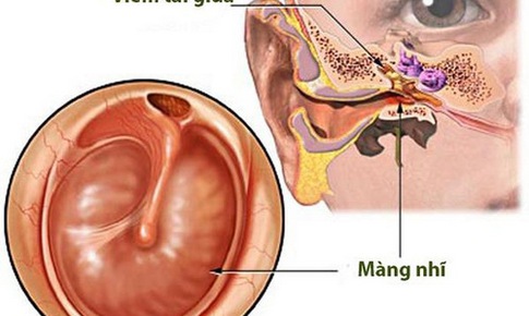 Chăm s&#243;c trẻ bị vi&#234;m tai giữa