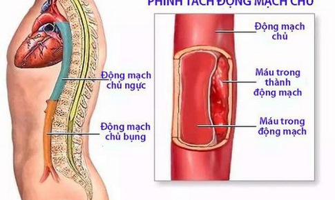 Dấu hiệu nghi ngờ ph&#236;nh mạch chủ bụng