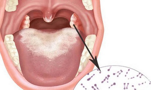 Những điều cần lưu &#253; khi d&#249;ng thuốc trị bạch hầu