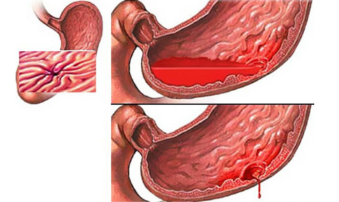 Xuất huyết ti&#234;u h&#243;a, xử tr&#237; thế n&#224;o?