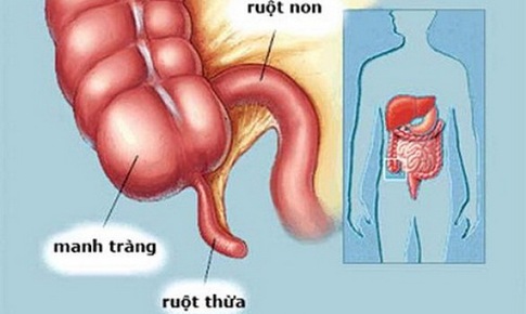 Kh&#244;ng chủ quan với vi&#234;m t&#250;i thừa manh tr&#224;ng