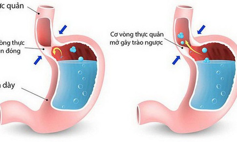 Cần ph&#225;t hiện sớm co thắt t&#226;m vị