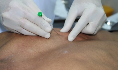 Cấy chỉ hỗ trợ trị nhiều bệnh