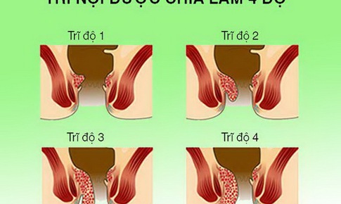 Bệnh trĩ gây khó chịu lâu dài