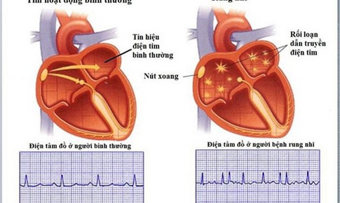 Đề ph&#242;ng đột quỵ do rung nhĩ