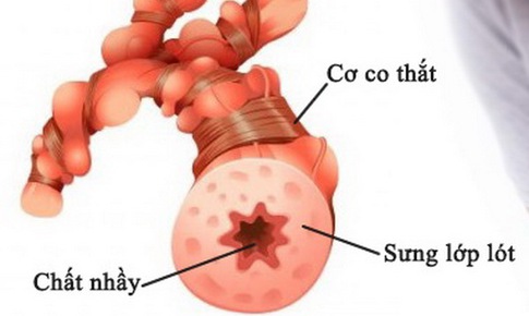 Bệnh nh&#226;n hen suyễn nếu mắc COVID-19 sẽ rất nguy hiểm