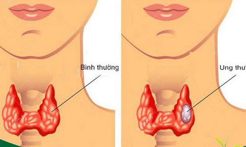 Ung thư tuyến gi&#225;p c&#243; thể chữa khỏi nếu ph&#225;t hiện sớm, chữa trị đ&#250;ng