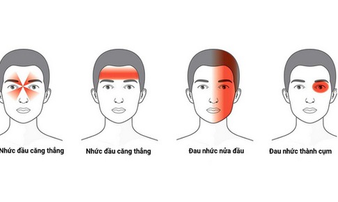 Đối ph&#243; với bệnh đau nửa đầu Migraine