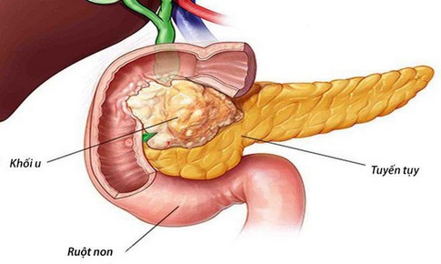 Nang giả tụy c&#243; thể g&#226;y vấn đề nghi&#234;m trọng