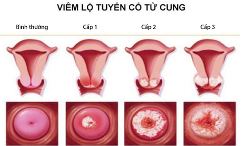 Một số tổn thương lành tính cổ tử cung