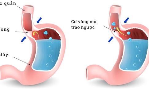 Tr&#224;o ngược dạ d&#224;y c&#243; g&#226;y h&#244;i miệng?