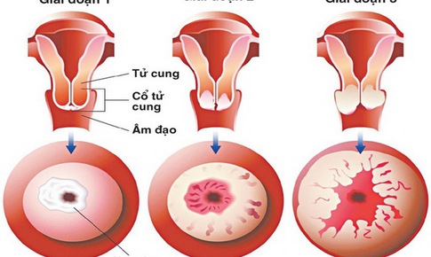 HPV g&#226;y ra ung thư g&#236;?