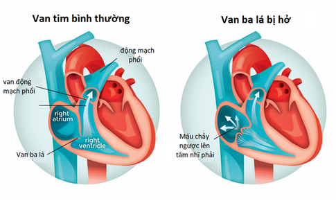 Hở van tim c&#243; dễ ph&#225;t hiện?