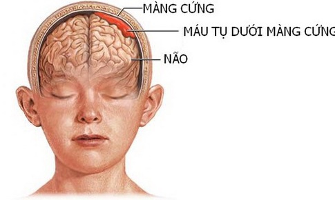 M&#225;u tụ dưới m&#224;ng cứng mạn t&#237;nh ở người cao tuổi