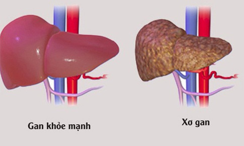 Nguy hại do xơ gan