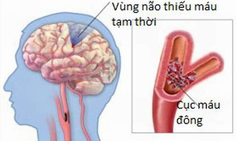 Chớ xem thường thiếu m&#225;u n&#227;o cục bộ tạm thời