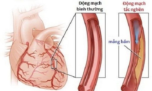 Bệnh mạch v&#224;nh ở người cao tuổi