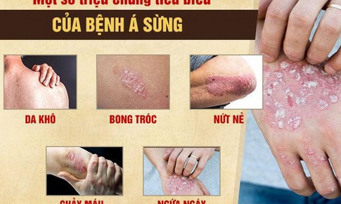 Đối ph&#243; với bệnh &#225; sừng