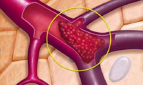 Huyết khối tĩnh mạch n&#227;o: Bệnh nguy hiểm, cần ph&#225;t hiện sớm