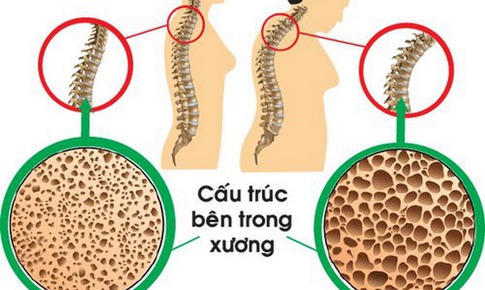 Thuốc trị lo&#227;ng xương: Sử dụng thế n&#224;o cho hiệu quả?