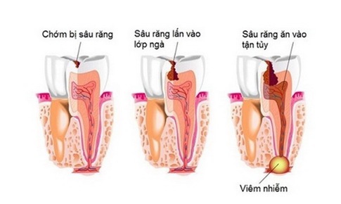 Đề ph&#242;ng biến chứng vi&#234;m xương tủy h&#224;m