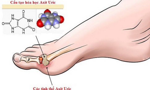 Xử tr&#237; tăng acid uric m&#225;u