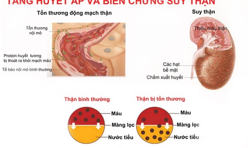 Dự ph&#242;ng tăng huyết &#225;p ở phụ nữ luống tuổi