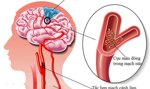 Cảnh gi&#225;c với cơn thiếu m&#225;u n&#227;o tho&#225;ng qua