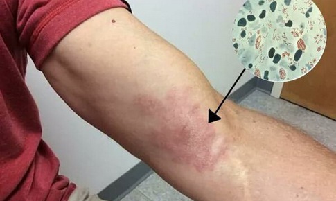 Từ ca mắc phong thể nhiều vi khuẩn giống Lupus ban đỏ Kh&#244;ng mất cảnh gi&#225;c với bệnh phong