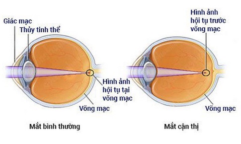 Kiểm so&#225;t tiến triển cận thị ở trẻ em