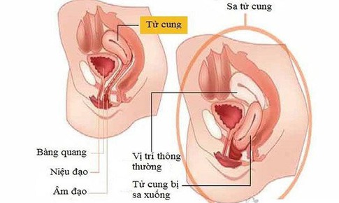 Sa sinh dục, bệnh kh&#243; n&#243;i...