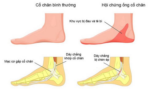 Chớ chủ quan với hội chứng đường hầm cổ ch&#226;n