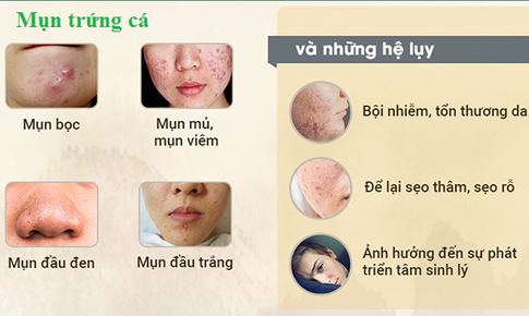 C&#225;ch hay để mụn trứng c&#225; “lặn tăm”