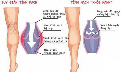 Hệ lụy do suy gi&#227;n tĩnh mạch